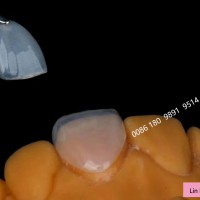 深圳义齿工厂 假牙厂家 认证定制式固定义齿产品